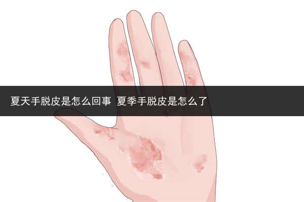 夏天手脫皮是怎么回事 夏季手脫皮是怎么了