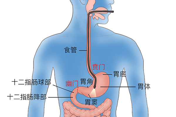 賁門癌是什么意思，賁門癌該怎么治療