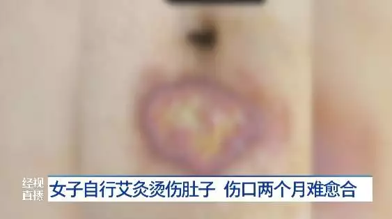 女子肚子上被燙出兩個(gè)水泡，傷口難愈合，醫(yī)生：冬季多發(fā)要謹(jǐn)防31歲在春晚一炮而紅，觀眾都以為他隱退了，其實(shí)已經(jīng)去世10年了